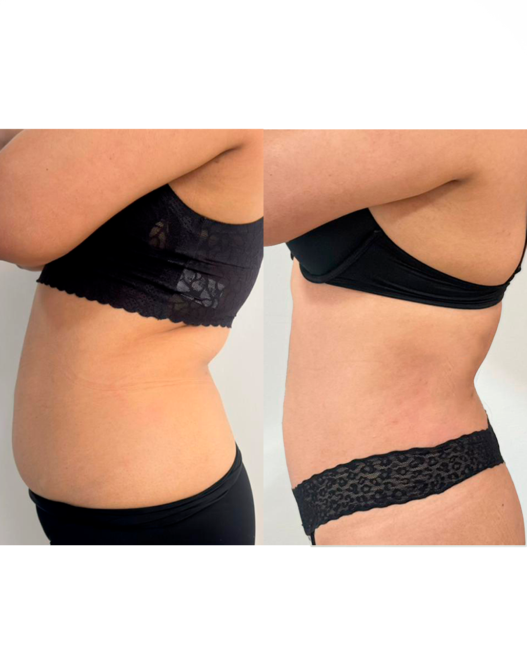Resultados de Endolifting Corporal
