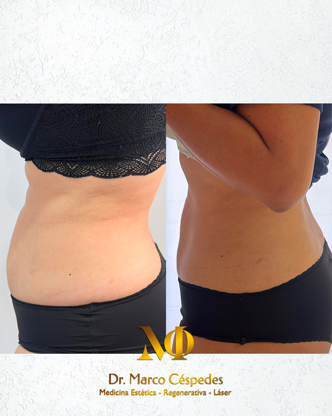 Resultados de Endolifting Corporal
