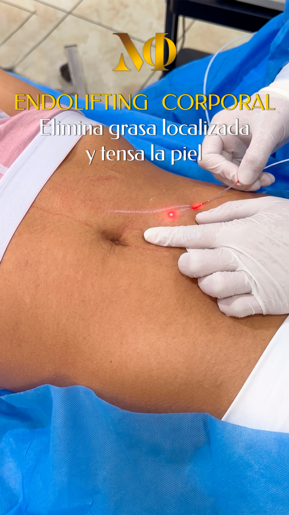 Endolifting Corporal