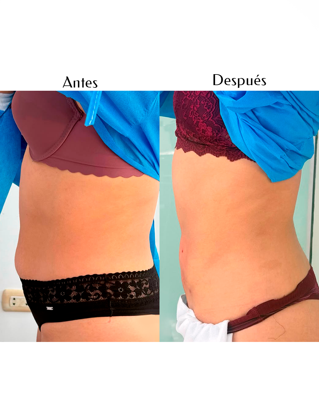 Resultados de Endolifting Corporal