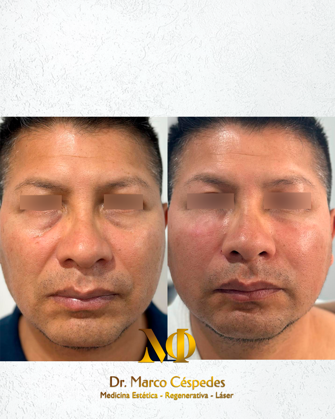 Resultados de Relleno de Surcos Nasogenianos con Ácido Hialurónico