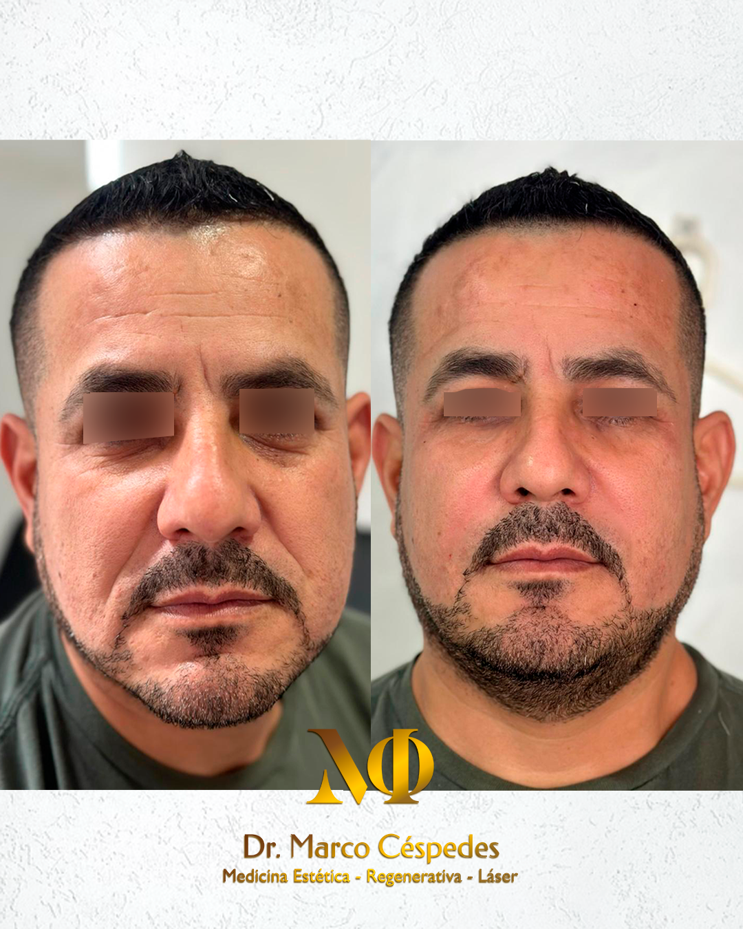 Resultados de Relleno de Surcos Nasogenianos con Ácido Hialurónico
