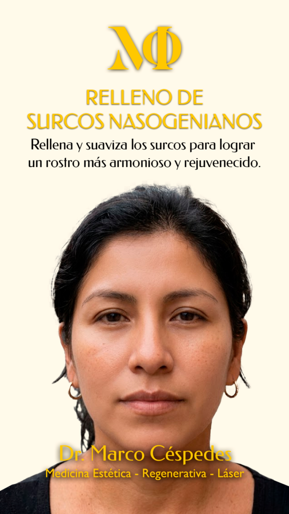Relleno de Surcos Nasogenianos con Ácido Hialurónico